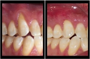 Pinhole Surgical Technique | William Linger, DDS, MAGD