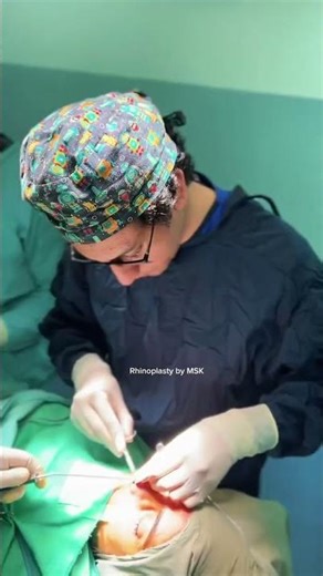 Rhinoplasty Transformation by Dr. Salman | Natural Nose Reshaping #drsalman #rhinoplasty