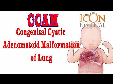 CCAM [ Congenital Cystic Adenomatoid Malformation ] of Lungs.