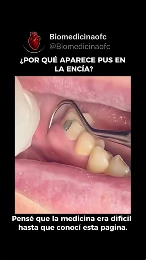 ¿POR QUÉ APARECE PUS EN LA ENCÍA? CONOCE LAS CAUSAS 🦷⚠️