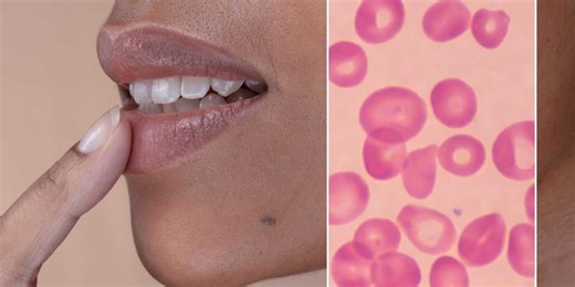 'I'm a dentist - the most telling signs of vitamin B12 deficiency often appear around the mouth'