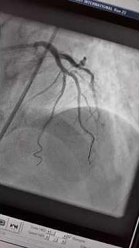 Bifurcation angioplasty: Dr Binoy John :The Crush Technique & Kissing Balloon Angioplasty