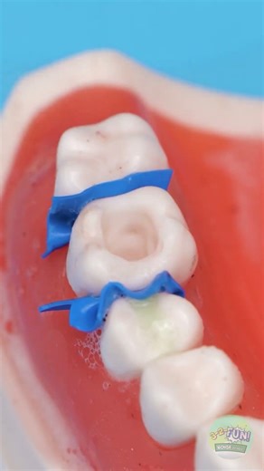 ما الذي يراه طبيب الأسنان أثناء إصلاح التجويف - عن قرب! 😳🔍