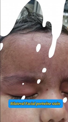 Sturge–Weber syndrome and Port-Wine Stain