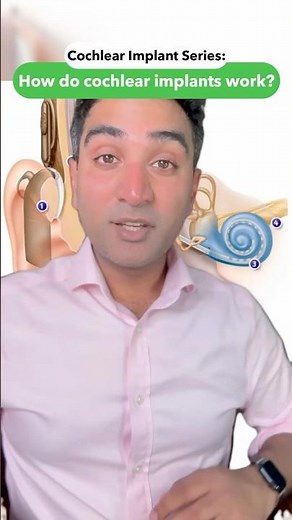 How does a Cochlear Implant work?