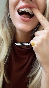 Andie on Instagram: "👅 . . . #braces #girlwithbraces #bracessmile #braceface #orthodontist #ortho #herbst #herbstappliance #telescopicappliance #rpe #rapidpalatelexpander #dentist #dental #powerchain #braceselastics #metal #mouthretractor #metalmouth #highpullcap #reversepullheadgear #facemask #reversepullfacemask #headgear #powerchain #ligatures #powerchains #teeth #mouth #lips #tongue #braced"