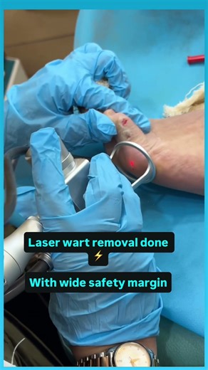 Plantar Wart Removal by Laser | Foot Wart Treatment | No Bleeding| Dr Ashima Goel MD Dermatologist