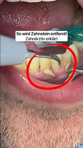 So wird Zahnstein richtig entfernt.