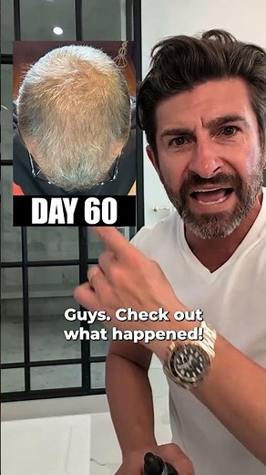 The 60-Day Hair Regrowth Transformation You Need To See To Believe!