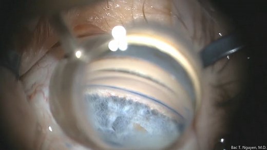 Trypan Blue for Angle Visualization - Eyetube