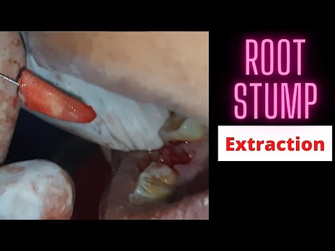 Root Stump Extraction With H file | How I remove root stumps | Dr. Sunil Kumar