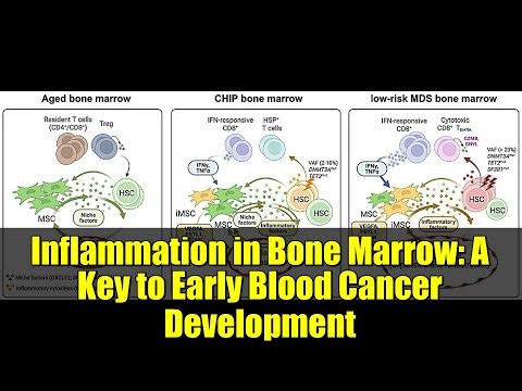 Inflammation in Bone Marrow: A Key to Early Blood Cancer Development