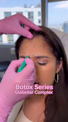 Comprehensive Guide to Glabellar Botox Techniques