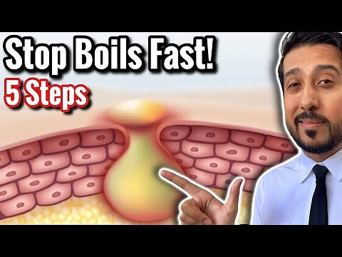 The #1 Way to Rid Painful Butt Boils Quickly | Boil Removal Tips