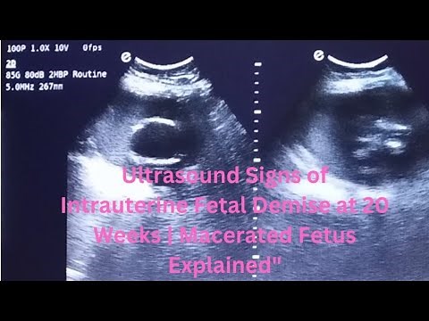 Ultrasound Signs of Intrauterine Fetal Demise at 20 Weeks | Macerated Fetus Explained"
