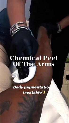 At Tanya Thomas Skin Clinic, we correct pigmentation on the face and the body — safely and strategically. Because clear skin shouldn’t stop at your jawline. Our clinical body peel is designed to gently resurface, refine texture, and gradually restore a more even, luminous tone — without compromising the integrity of the skin. #BodyPigmentation #ChemicalPeelExpert #SkinOfColorSpecialist #EvenToneSkin #CorrectiveSkincare