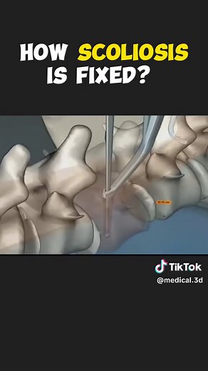 Scoliosis Surgery 3D Animation #spinalfusion #spinalfusionsurgery #spinalfusionsurvivor #spinalfusionsurgeryrecovery #spinalfusionrecovery #scoliosis #scoliosisawareness #scoliosistreatment #scoliosissurgery #medical3danimation #3dmedicalanimation