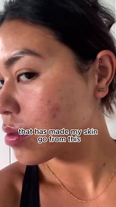 I struggled with hormonal acne all of 2022 and when I finally found what worked to clear my active acne, I was left with scars and hyperpigmentation. The @omniluxled Contour Face Mask along with monthly facials and a daily gentle hydrating skincare routine helped me get here & if acne scars and dark spots are something you struggle with, this is for you! | Omnilux