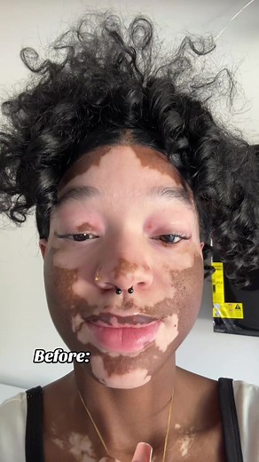 Transforming Skin with Vitiligo: Before and After