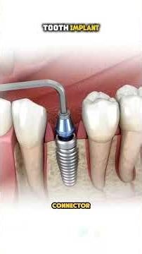 Tooth Implant Procedure 🦷 | Step-by-Step Smile Restoration Guide #dental #oralhealth #dentalcare