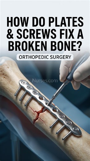 How Do Plates & Screws Fix a Broken Bone? 🦴🔩 | Fracture Fixation Explained