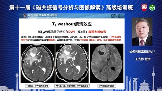 个人自学，DWI的廓清效应，T2和ADC高信号，但DWI信号不高，见于血管源性水肿，王光彬