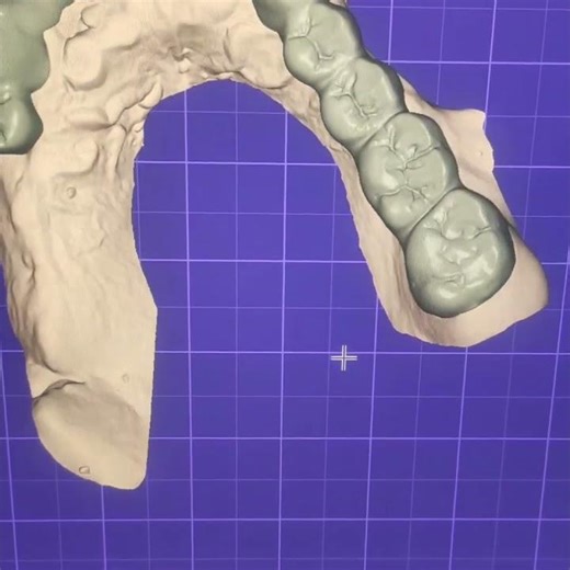 #dentalcaddesign #cadcam #dentist #animation #