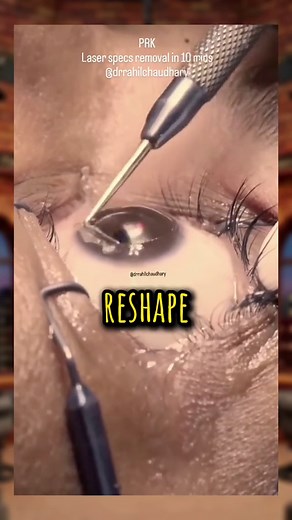 Laser Eye Surgery: The Painful Process Revealed