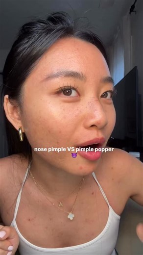 ALLIE CHEN on Instagram: "i hate nose pimples they are the worst😐😐 at least i have my ways of getting rid of it… thank goodness for @anua_global @herocosmetics #acneproneskin #acneskincare #acnejourney #pimples #relateable"
