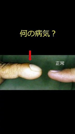 【ばち指】指先が変形しています ＃Shorts