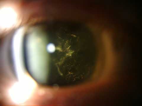 Schaffer's Sign Retinal Detachment Slit Lamp Video