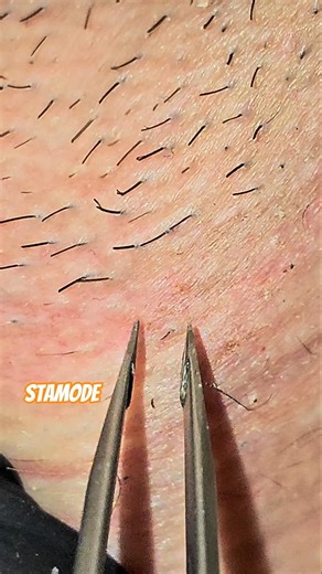 Close-Up Tweezing — Smooth Beard Hair Removal 😌