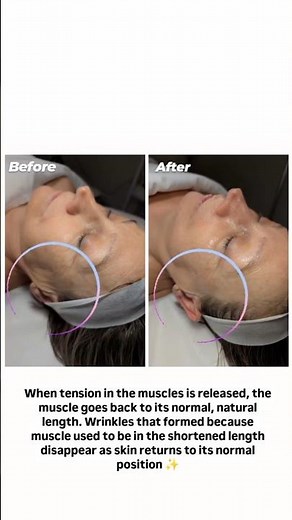 Buccal Massage releases tension in the face #buccalmassagetoronto