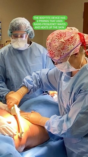 Let’s rewind back to May for this fantastic #BodyTite procedure done by Dr. Macias! The BodyTite procedure helps contour the body using liposuction and radio-frequency technology. The BodyTite device has 2 prongs that transmits radio-frequency waves and heats up the skin. #plasticsurgery #bodycontour #beforeandafter #sundayrewind #thecentrepc #mishawaka #granger #southbend | The Centre, P.C. | Facebook