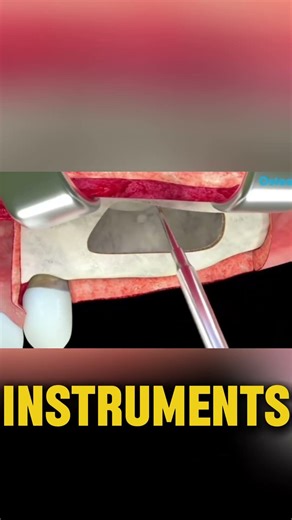 Bone Grafting for Dental Implants: The Sinus Lift Procedure #shorts #implant