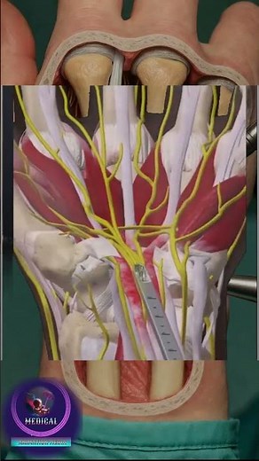 How Carpal Tunnel Surgery Restores Hand Function (3D Animation)