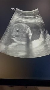 5.8K views · 289 reactions | Anencephaly fetus #anencephaly #anencephalyfetus #ultrasoundmadeeasy | Ultrasound made easy | Facebook