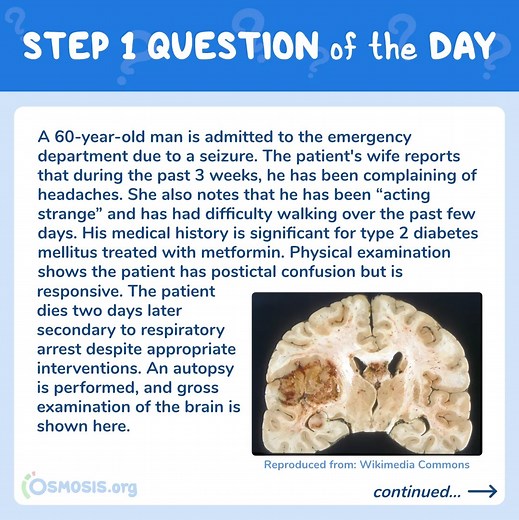 USMLE® Step 1 Question of the Day: Glioblastoma Multiforme - Osmosis Blog