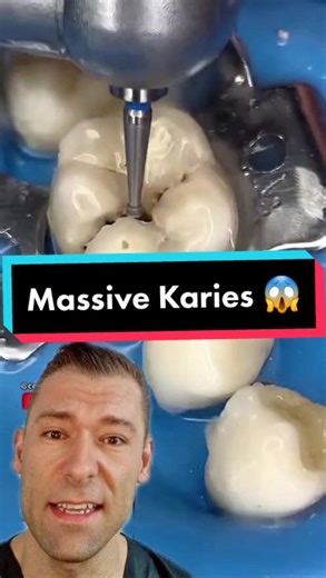 Massive Karies unter der Fissur 😱