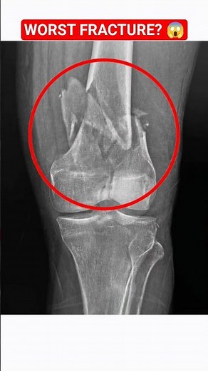 Insane Knee Fracture 😱 | Can You Handle This X-ray?