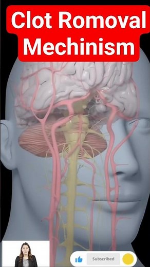 3D Animation: Thrombectomy in Stroke | How Brain Clot Removal Restores Blood Flow
