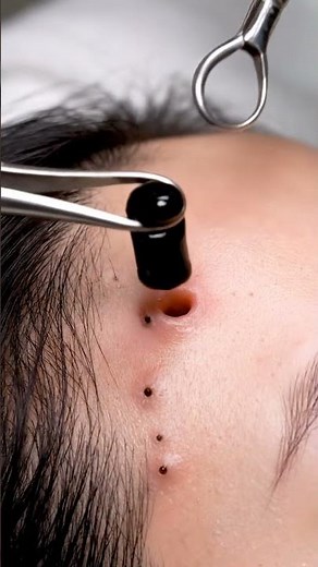 “Satisfying Deep Pore Extraction — Blackheads Gone!”