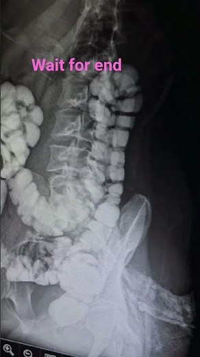 x ray distal lopogram#youtubeshorts #anatomy #medicalimaging #shortfeed #doctor #xray