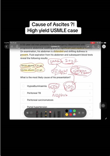 Understanding Ascites Causes in USMLE Cases