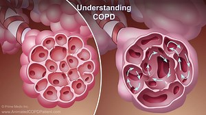 COPD (Chronic Obstructive Pulmonary Disease) is a long-term lung disease that makes it difficult to breathe. This animated video explains more. Please watch and share to help increase awareness! #COPD | Animated Patient