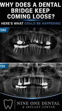 🦷 Why Does a Dental Bridge Keep Coming Loose? Here's What Could Be Happening