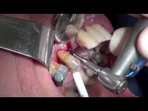 Immediate Dental Implant Surgery - Upper Premolar - Surgery Explicit