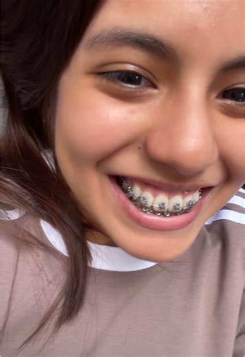 Brackets: My Ortodontia Journey and Experience
