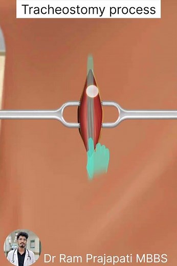 Tracheostomy Procedure Explained 🩺 | Medical Animation