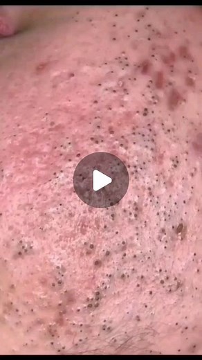 Pimple Popping 2021 | Like this video for PART 2...#fyp #pimplepoppingvideos | Instagram